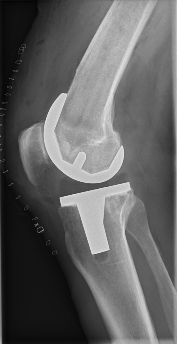 Röntgenbild eines menschlichen Beins mit einem Kniebruch einschließlich eines Ligaments.
