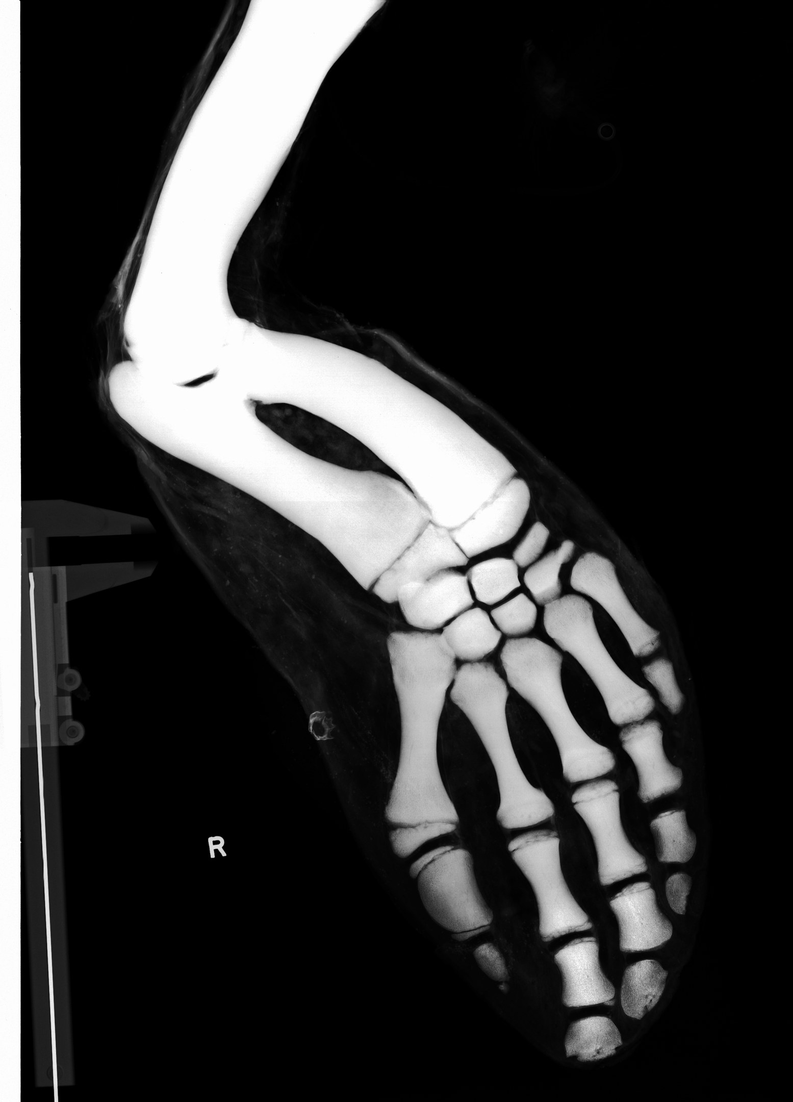 Röntgenbild eines menschlichen Beins mit einem Knöchelbruch mit detaillierter Ansicht der Knochen und Bänder.