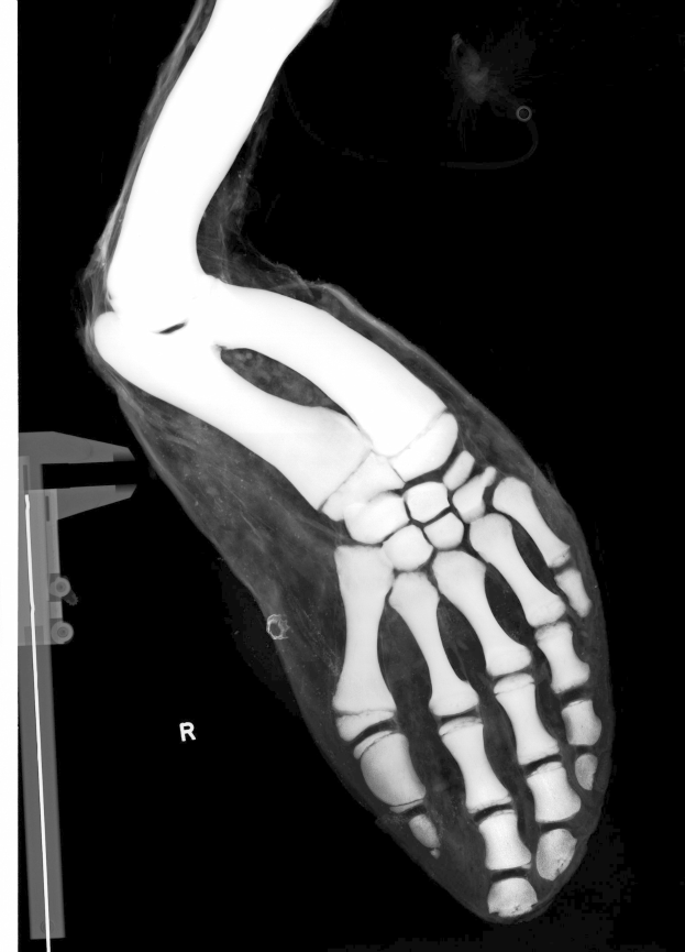 Röntgenbild eines menschlichen Beins mit einem Knöchelbruch mit detaillierter Ansicht der Knochen und Bänder.